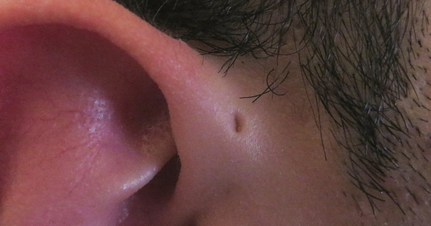 Les Petits Trous Près des Oreilles : Une Explication Scientifique