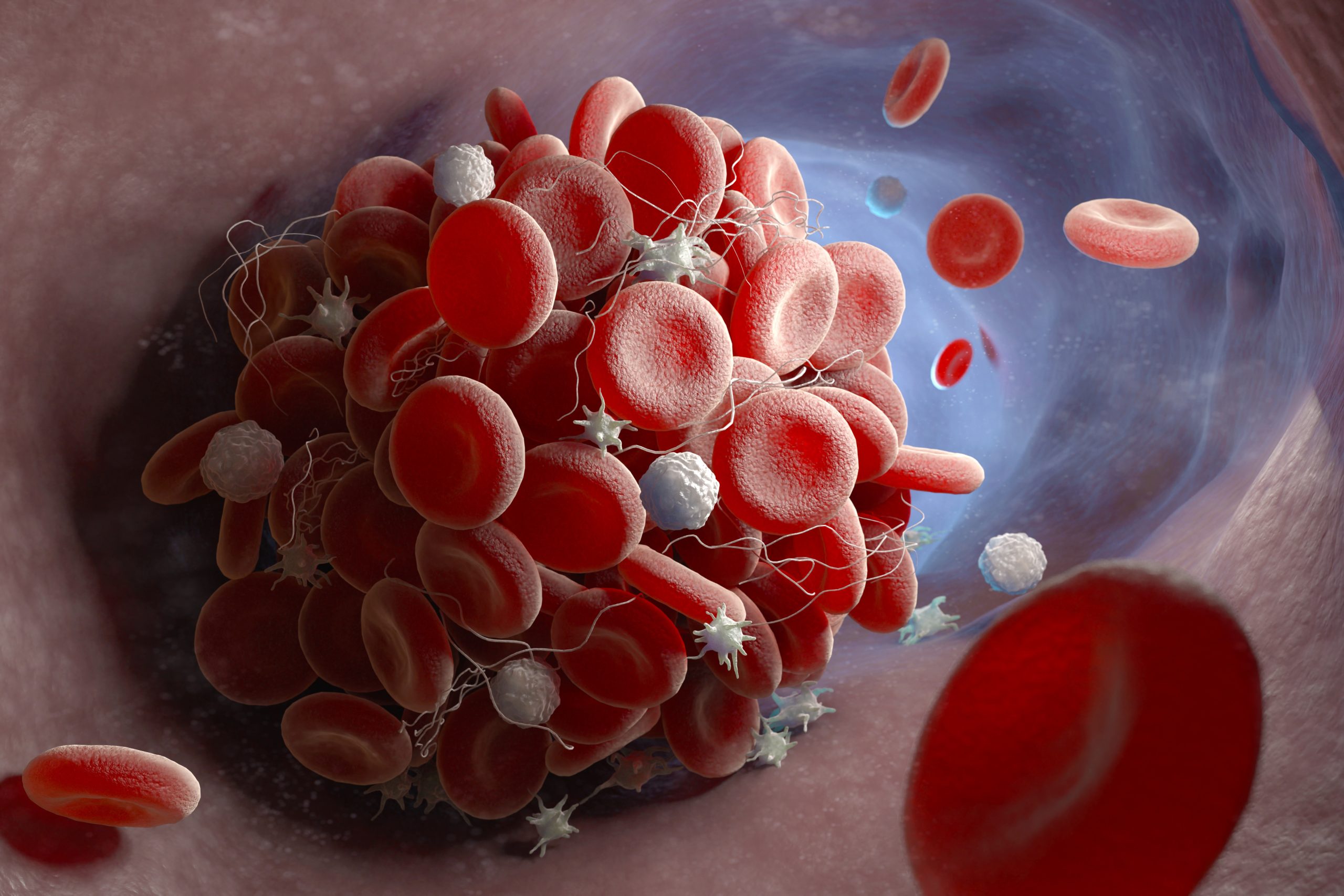 La thrombose : l’ennemi silencieux qui peut bouleverser votre vie en un instant