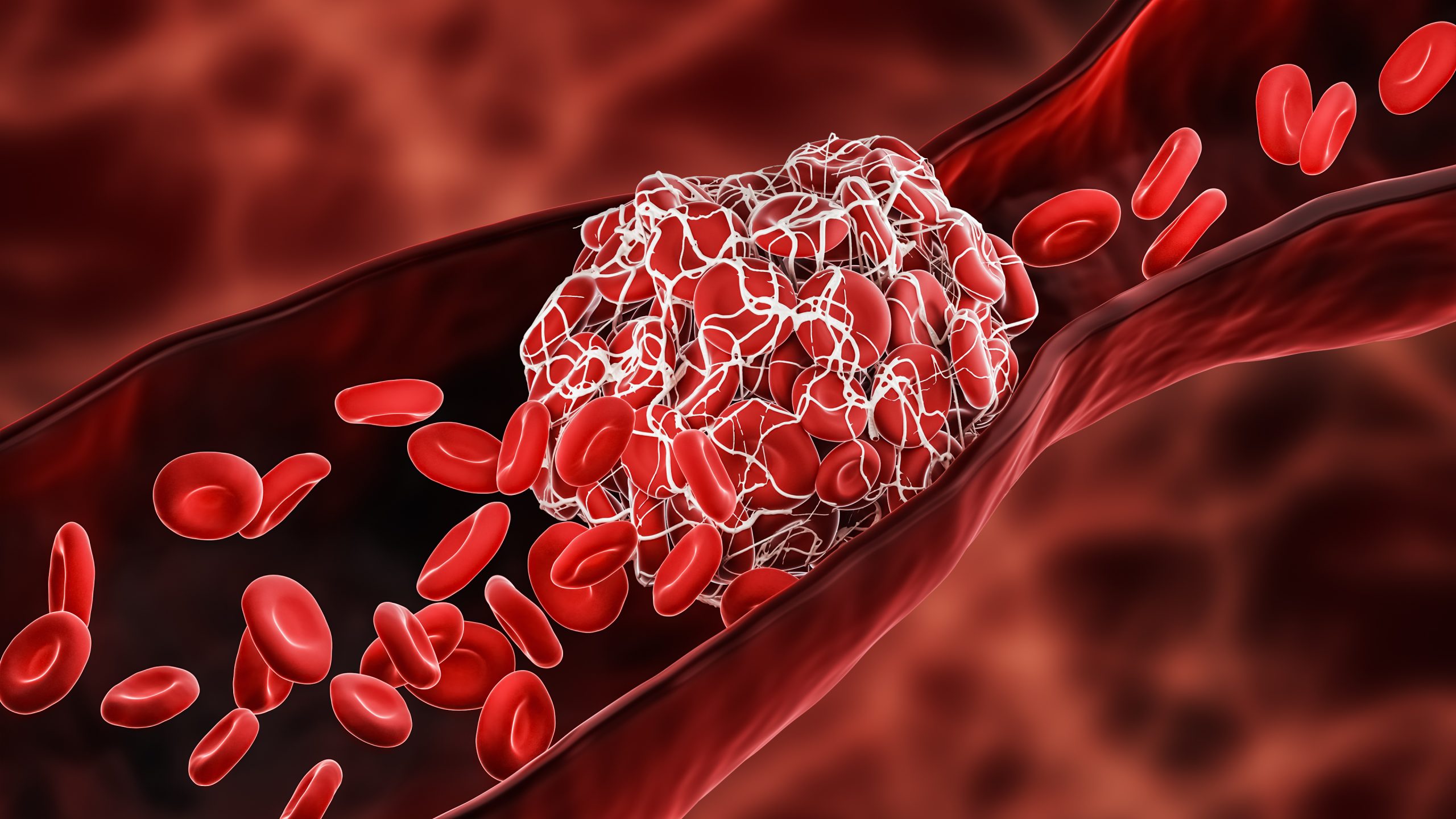 Pourquoi la thrombose est-elle si dangereuse ?