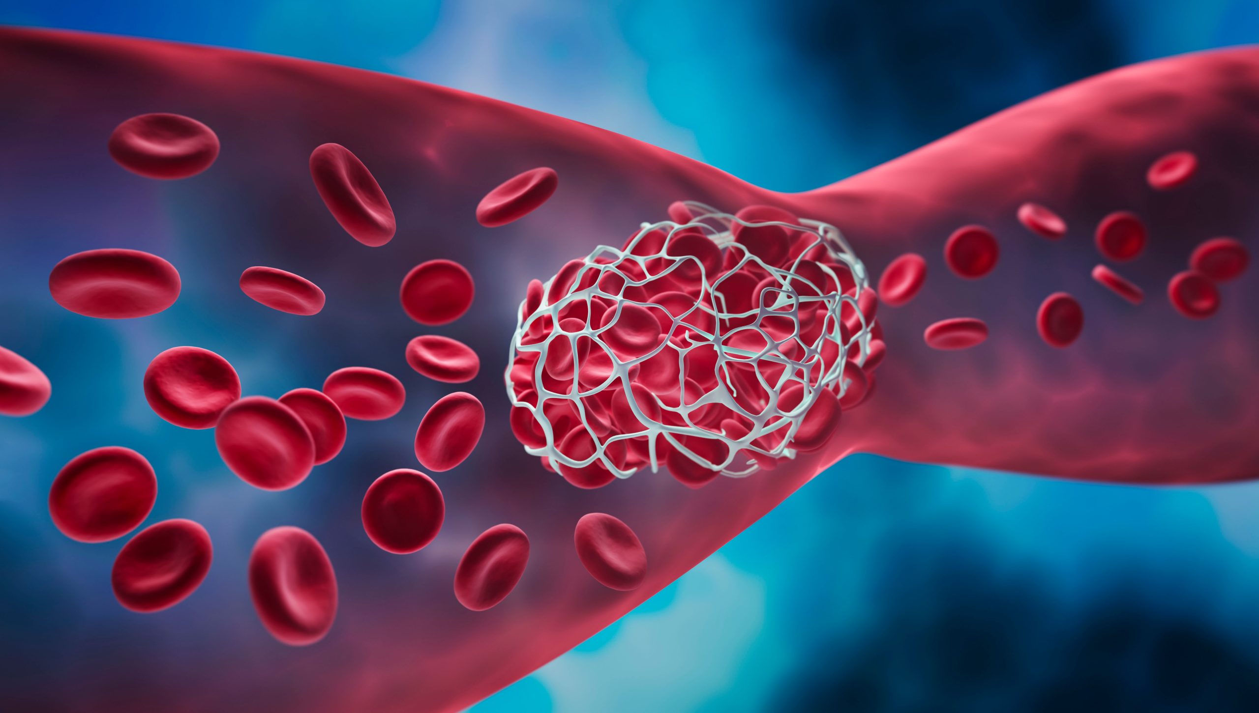 Qu’est-ce que la thrombose ?