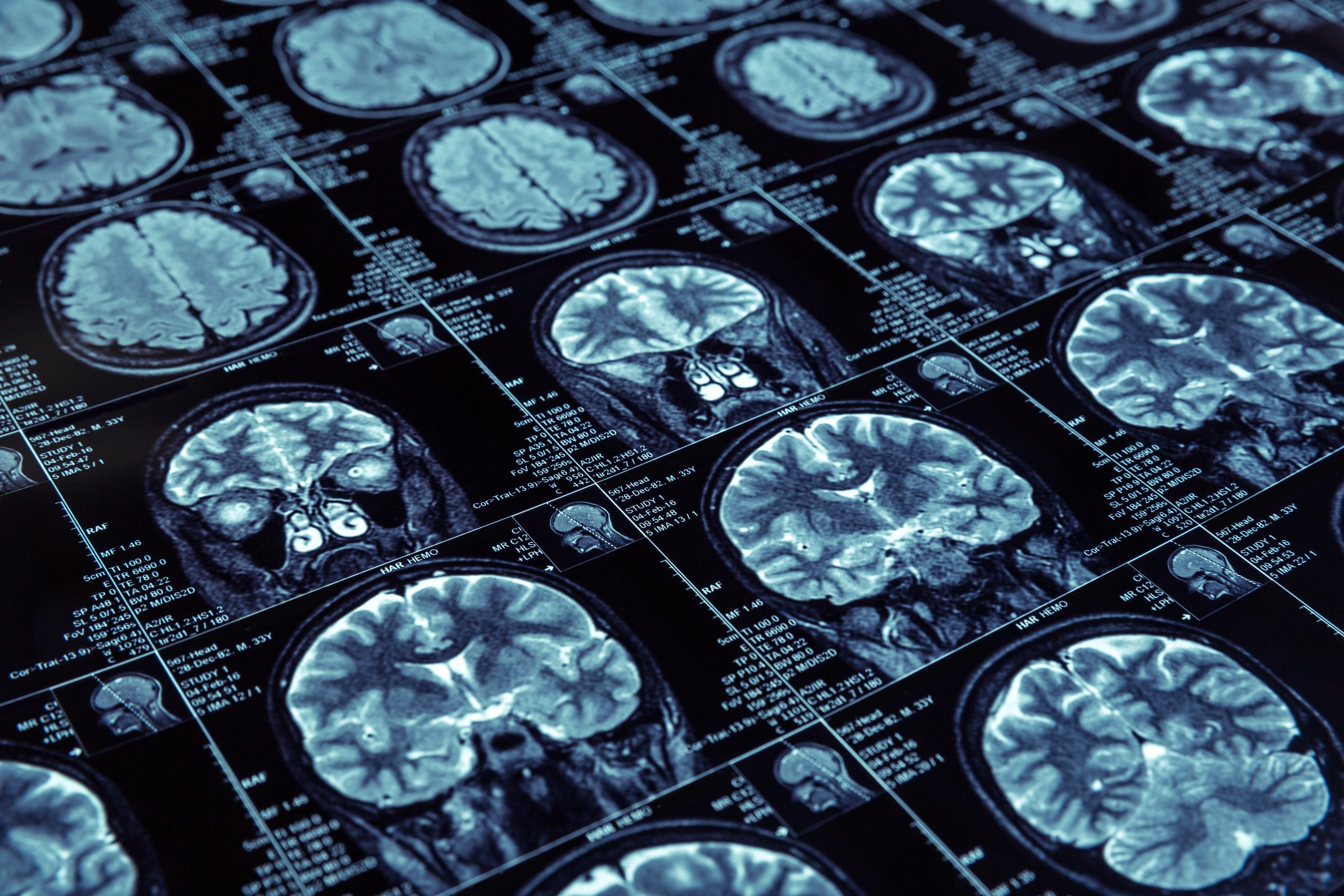 Des Résultats Bluffants : Détecter Alzheimer Avant les Troubles de la Mémoire