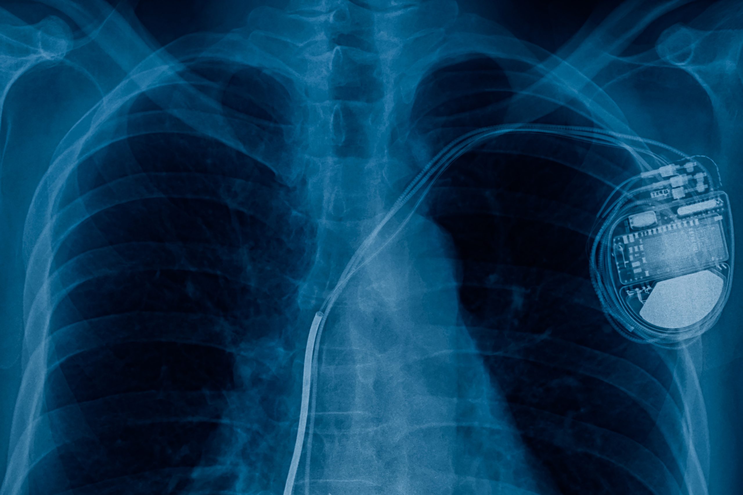 Un pacemaker ultra-miniature pour un impact maximal