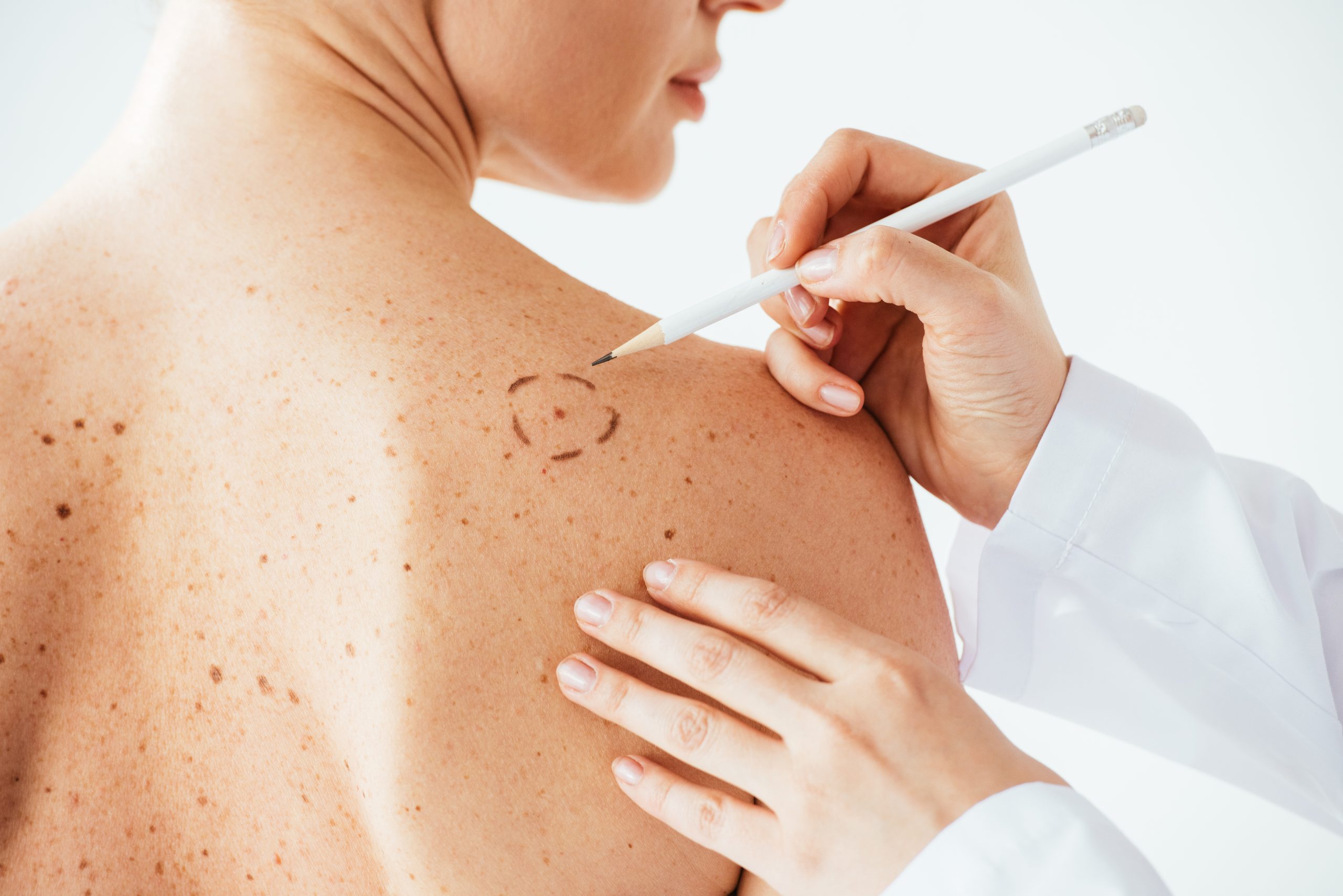 Comment reconnaître un mélanome ?