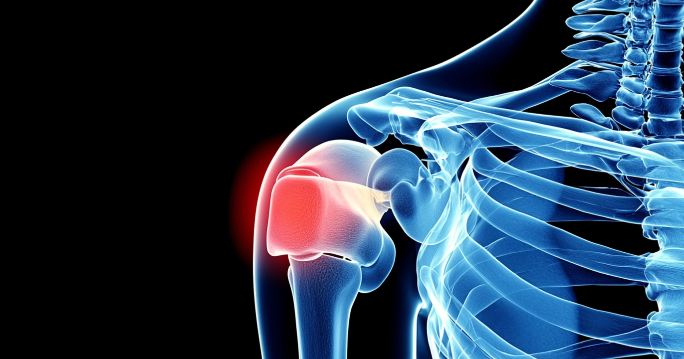 Épaule gelée : une condition douloureuse affectant silencieusement des millions de femmes de la quarantaine