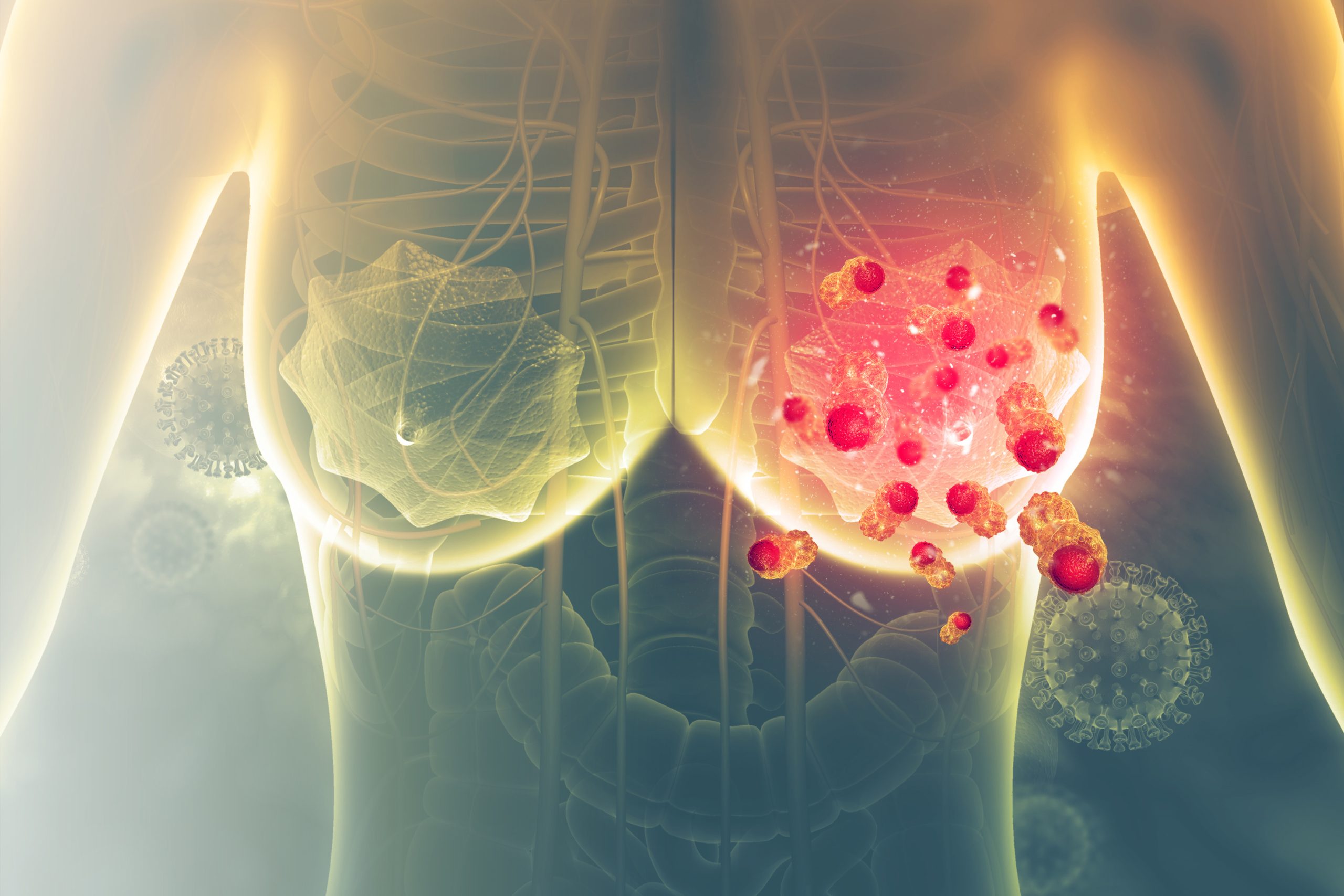 Révolution dans le traitement du cancer du sein : la technique des microbilles explosives à ultrasons