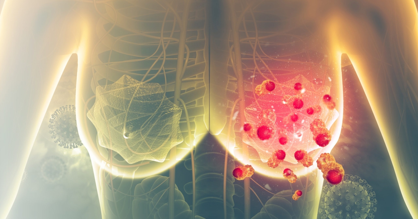Révolution dans le traitement du cancer du sein : la technique des microbilles explosives à ultrasons