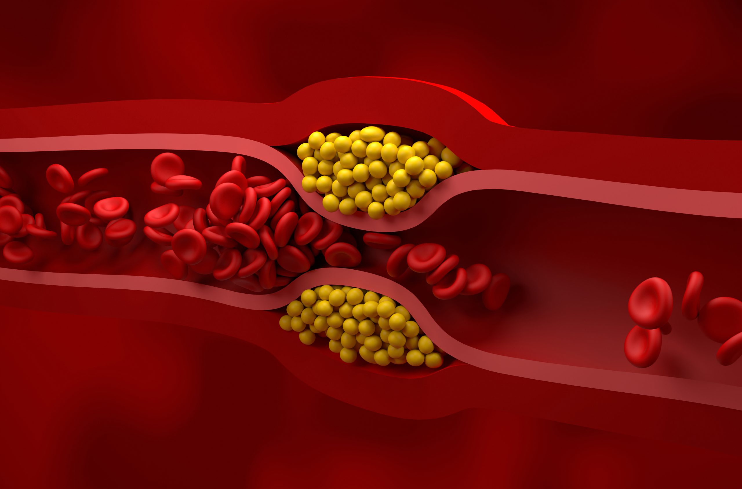 Une nouvelle thérapie contre le cholestérol réduit les niveaux de 69 % après une seule dose