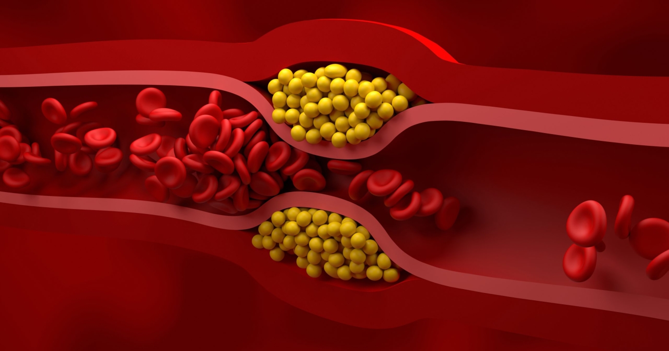 Une nouvelle thérapie contre le cholestérol réduit les niveaux de 69 % après une seule dose