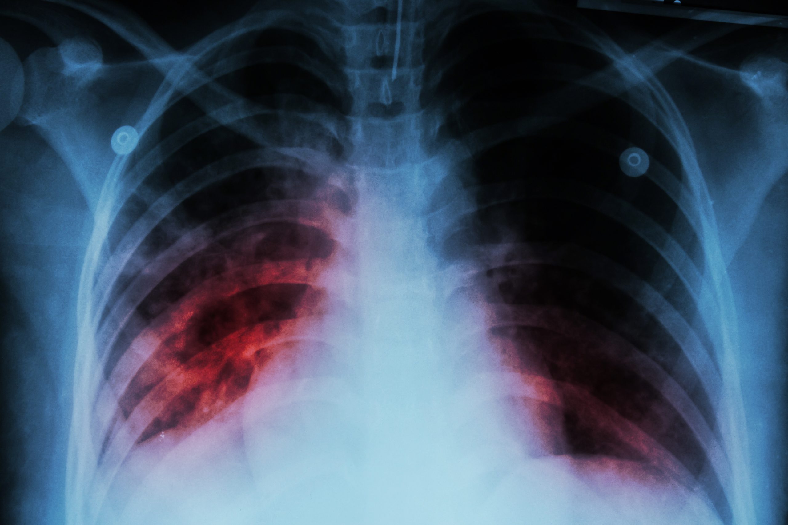 Pour la tuberculose : espoir comparable à l’éradication de la variole